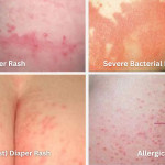 Different Types of Diaper Rash Pictures